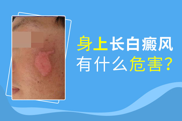 白癜風危害,白癜風的影響